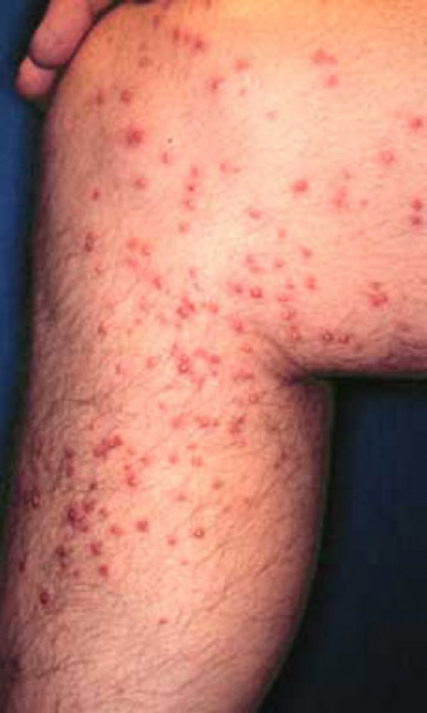 BugMatser Pest Control Kelowna fire ant bite